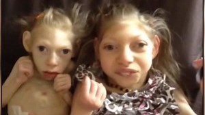 Family raises two daughters with microcephaly