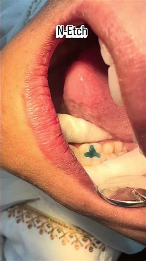 Light cure restorative flowable composite filling 🦷