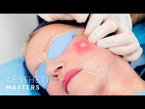 Facelift without Surgery - Endolift Laser