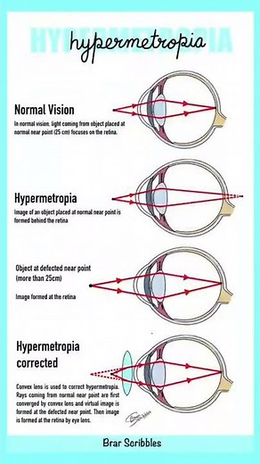 Defects in Human Eye: Myopia & Hypermetropia | Study Guide & Tips | Fun Science Learning