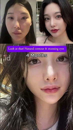 Korea Plastic Surgery: Perfectly done: Soft contours + Sharp eyes