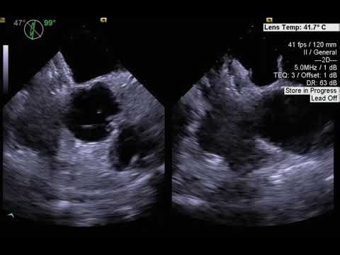 PFO after occluder device placement.