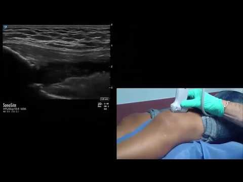 Step-by-Step Ultrasound Guided Intra-Articular Knee Aspiration/Injection Procedure