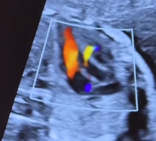 #fetalcardiology #fetalheart #vsd #perimembranousvsd #muscularvsd #outletvsd #inletvsd #fetalultrasound #fetalecho #chd #congenitalheartdisease #lvot #rvot #3vv #3vt #colordoppler #ultrasoundtips… | Coskun Umit