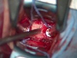 Anterior Cervical Discectomy and Fusion at C3–C4 (ACDF) • Video • MEDtube.net