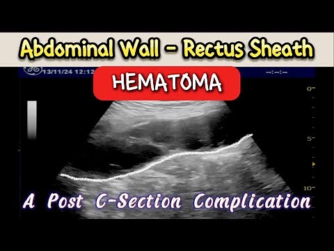 Abdominal Wall ( Rectus Sheath ) Hematoma - Post C-Section Complication