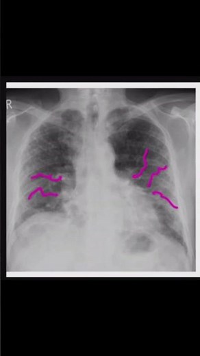 chest X ray #ultrasound #xray #shorts #shortvideo