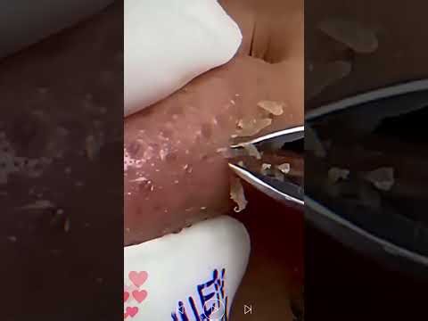 Skincare | Blackheads Removal #853 #tweezers skincare #blackheads blackheads