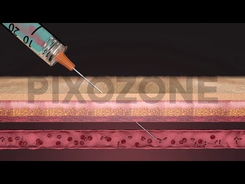Aesthetic surgery Injections Extended Animation