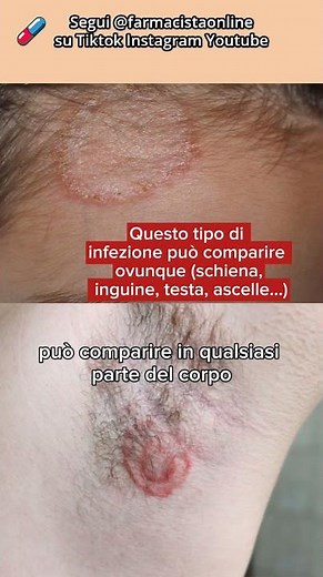Fungal infections the easy way #skinfungus #mycosis #skinhealth