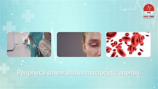 NNL ONE (Nursing Next Live Redefined) on Instagram: "🩺 Case Study: The Vegetarian Patient & Macrocytic Anemia 🩸 Can you solve this clinical mystery? 🕵️‍♂️ We have an elderly patient on a strict vegetarian diet presenting with easy fatigability and pallor. The Lab Report Breakdown: Hemoglobin: 9 g/dL (Anemic) MCV: 112 fL (Macrocytic) Serum Homocysteine: Elevated ⬆️ Serum Methylmalonic Acid: Normal ✅ Based on these biochemical markers, what is the most probable cause of this patient's anemia? �