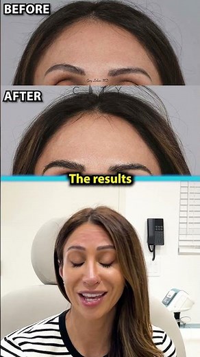 INCREDIBLE RESULTS | Eyebrow Hair Transplant With Doctor Gary Linkov