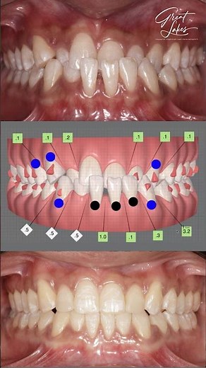 Clear Aligners for Dental Crossbite Correction - #invisalign #clearaligners #beforeandafter #braces