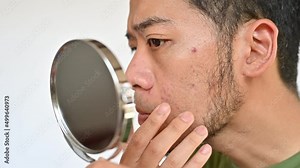 Worried Asian man saw the problem of pimple or acne occur on his face by a mini mirror. Conceptual shot of Acne and problem skin on male face.