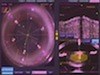 A Typical LenSx Laser Procedure - Eyetube