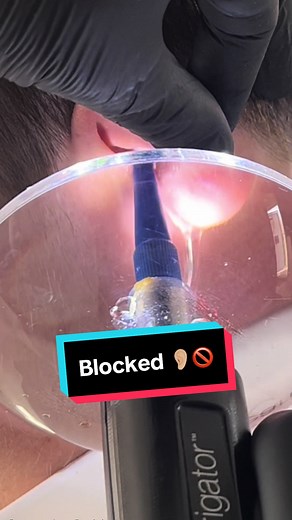 Effective Ear Wax Removal Techniques and Solutions