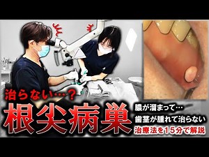 [Pus has accumulated and won't heal...] ​​A 15-minute explanation of how to treat "apical lesions...