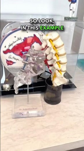 This simplifies WHY we use SPACERS and cages in #spinalfusions 🤷‍♂️👍✅ #education #spine #surgery