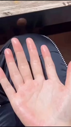 Uni Medical care on Instagram: "Polydactyly, defined as the presence of extra fingers or toes, is a relatively rare genetic condition occurring in approximately 1 in 500 to 1,000 live births. Although most cases involve incompletely formed or malformed extra fingers, often lacking functional joints, there are exceptional cases in which a fully functional extra finger develops. The development of the extra finger depends on abnormal embryonic development, with the extra finger receiving adequate