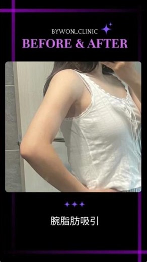 二の腕が別人級に細くなる脂肪吸引 #shorts #韓国整形 #脂肪吸引