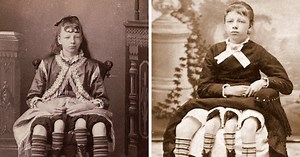 Myrtle Corbin mala neobyčajný život. Štvornohá dievčina z Texasu čelila rôznym výzvam, pri tehotenstve ju čakal šok | interez.sk