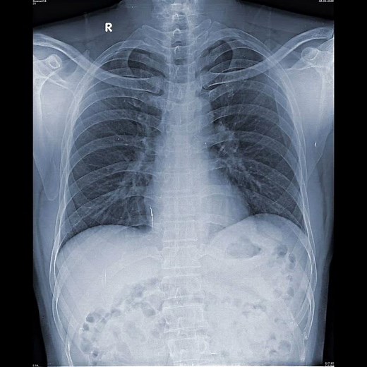 Barium Swallow #shortsvideo