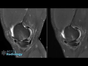 5 Minute Knee MRI (Fast vs. Standard Protocol)
