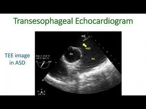 What is Transesophageal Echocardiogram (TEE)?