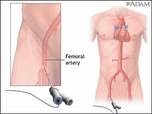 经皮冠状动脉腔内成形术 (PTCA)