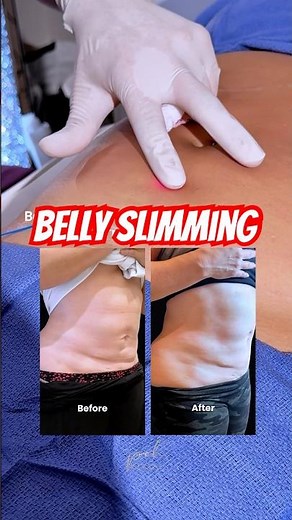 I Tried Lipo Laser for a Sleeker Abdomen - Check Out My Results!