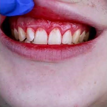 Signs of Gum Disease - Audley Dental