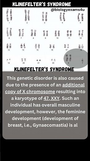 Klinefelter's Syndrome -Turner's syndrome -Down's Syndrome | Chromosomal Disorder