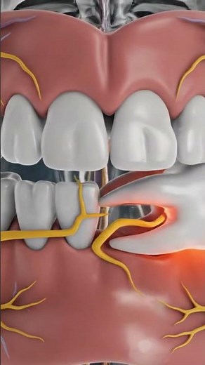 “Sideways Wisdom Tooth Causing Pain See What’s Happening Inside” #3danimation #medicaleducation