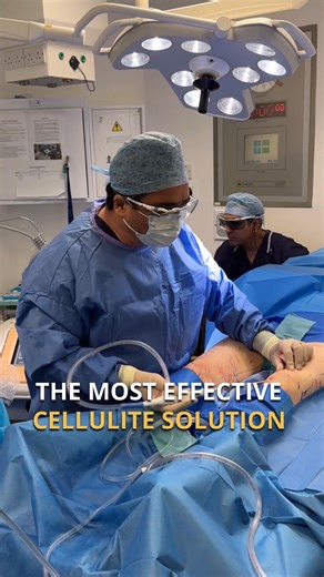 Dr Ayham AlAyoubi on Instagram: "Why is Cellulaze considered one of the most advanced treatments for cellulite reduction? Mr Ayoubi explains how Cellulaze works beneath the surface of the skin to target the structural causes of cellulite, not just the visible dimpling. By releasing fibrous bands, stimulating collagen production, and improving skin thickness, it delivers smoother, firmer-looking results with long-lasting improvement At LMA Clinic, advanced technology is combined with experience a