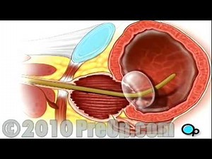 PreOp® Patient Education TURP of the Penis with PostCare Tasks