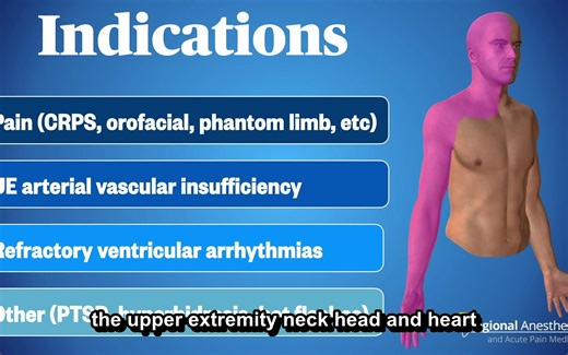 超声引导星状神经节阻滞（杜克大学 英文字幕）