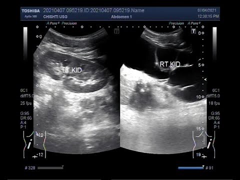 PUJ narrowing also called Ureteropelvic juncture (UPJ) obstruction in a child of about 7 years.