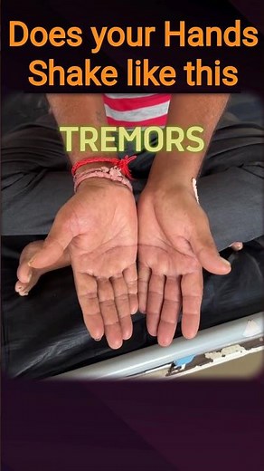 Is Hand Shaking Dangerous? Doctor Explains 🩺 #tremors #health #parkinson