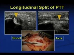 sonography MSK US of the Ankle