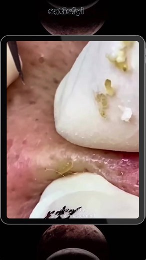 Squeeze Popping Acne Pimple Satisfying Abcess Blackheads Removal Pimple Removal | Viral #blackheadsremoval #cleanskin #acnetreatment #pimplepopping #foryoupage