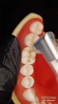 Class I Cavity Preparation | Lower First Molar (Tooth #36) | Dental Student Tutorial