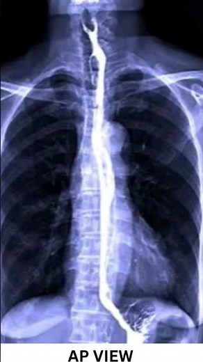 Barium swallow procedure