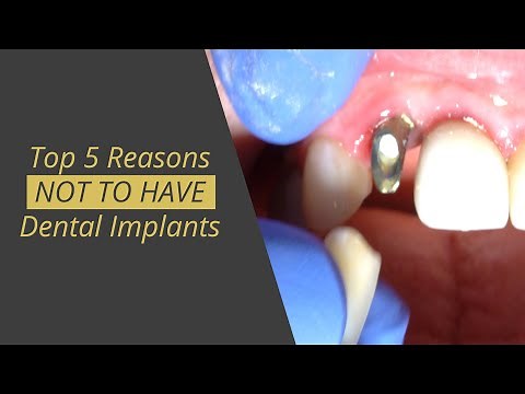 5 Reasons that Dental Implant Are NOT as good as teeth