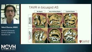 TAVR: Guidelines for TAVR vs. SAVR, VIV and Antithrombotic Therapy. What Are the Challenges of TAVR in AR Usage?