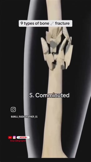 Types of Bone Fractures | Simple Explanation with Examples 🦴
