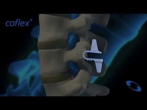 coflex® Non-Fusion Implant in Flexion and Extension | Paradigm Spine