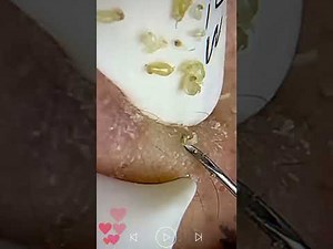 blackhead removal from nose/ old aged blackheads removal
