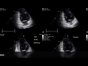 Abnormal Dobutamine stress echocardiogram