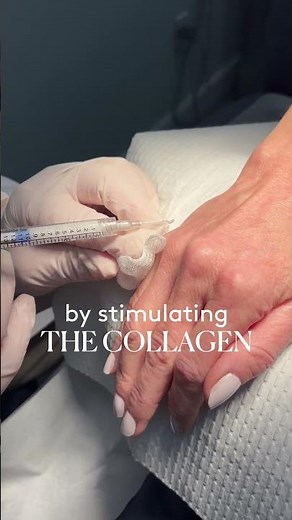 Watch Dr. Sobel restore volume and smooth the appearance of aging hands using Radiesse.