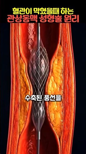 Principles of Coronary Angioplasty for Arteriosclerosis